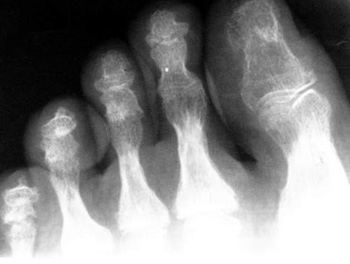 Заболевания мягких околосуставных тканей