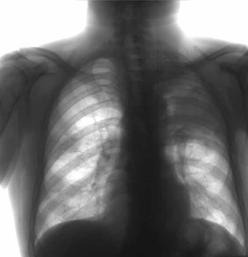 Лечение туберкулёза