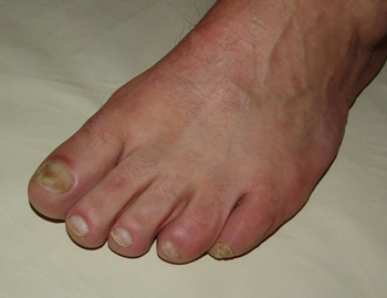 Недорогое лечение грибка