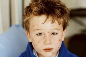 Ветрянка - симптомы и лечение