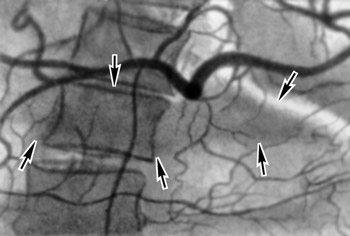 Панкреатит