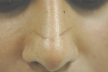 Методы эффективного удаления шрамов