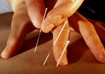 Рефлексотерапия