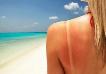 Солнечный ожог